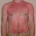 UV radiation from the Sun health risks for skin and eyes